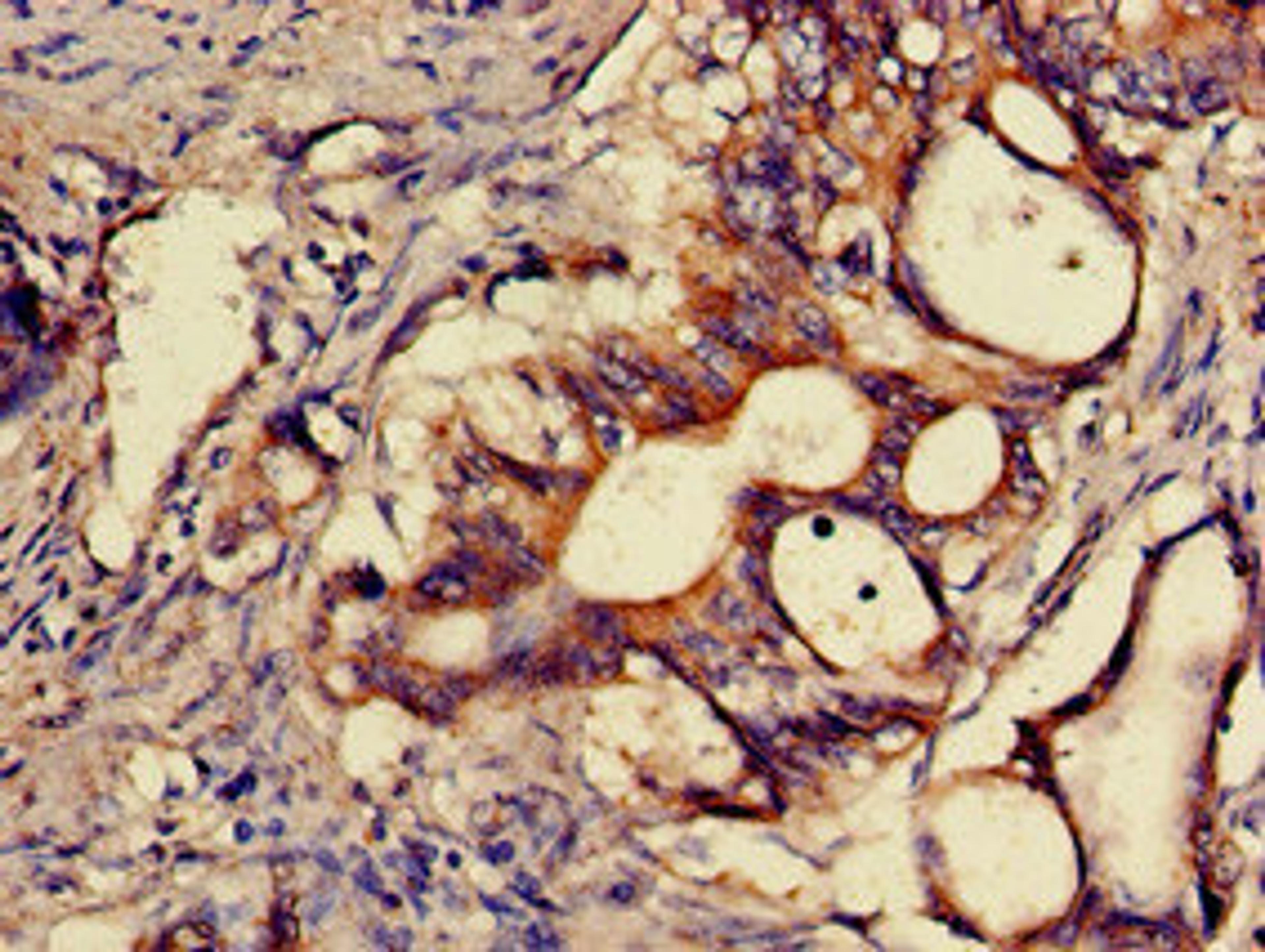 Immunohistochemistry of paraffin-embedded human colon cancer using CSB-PA882091LA01HU at dilution of 1:100