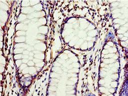 Immunohistochemistry of paraffin-embedded human colon cancer using CSB-PA005510ESR1HU at dilution of 1:100