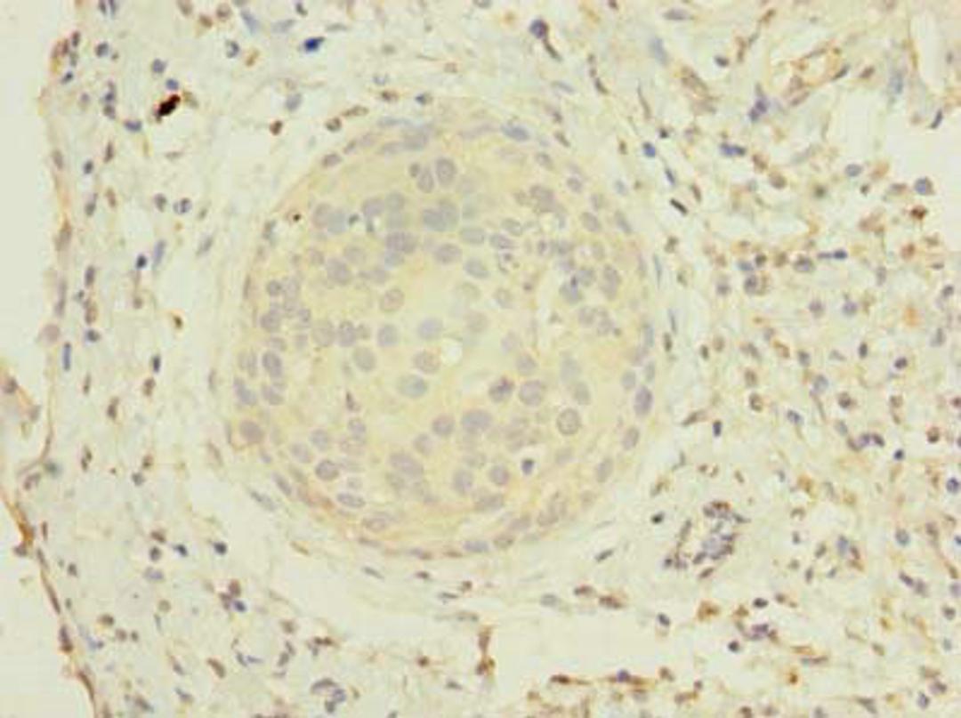 Immunohistochemistry of paraffin-embedded human cervical cancer using CSB-PA856963LA01HU at dilution of 1:100