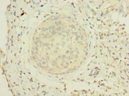 Immunohistochemistry of paraffin-embedded human cervical cancer using CSB-PA856963LA01HU at dilution of 1:100