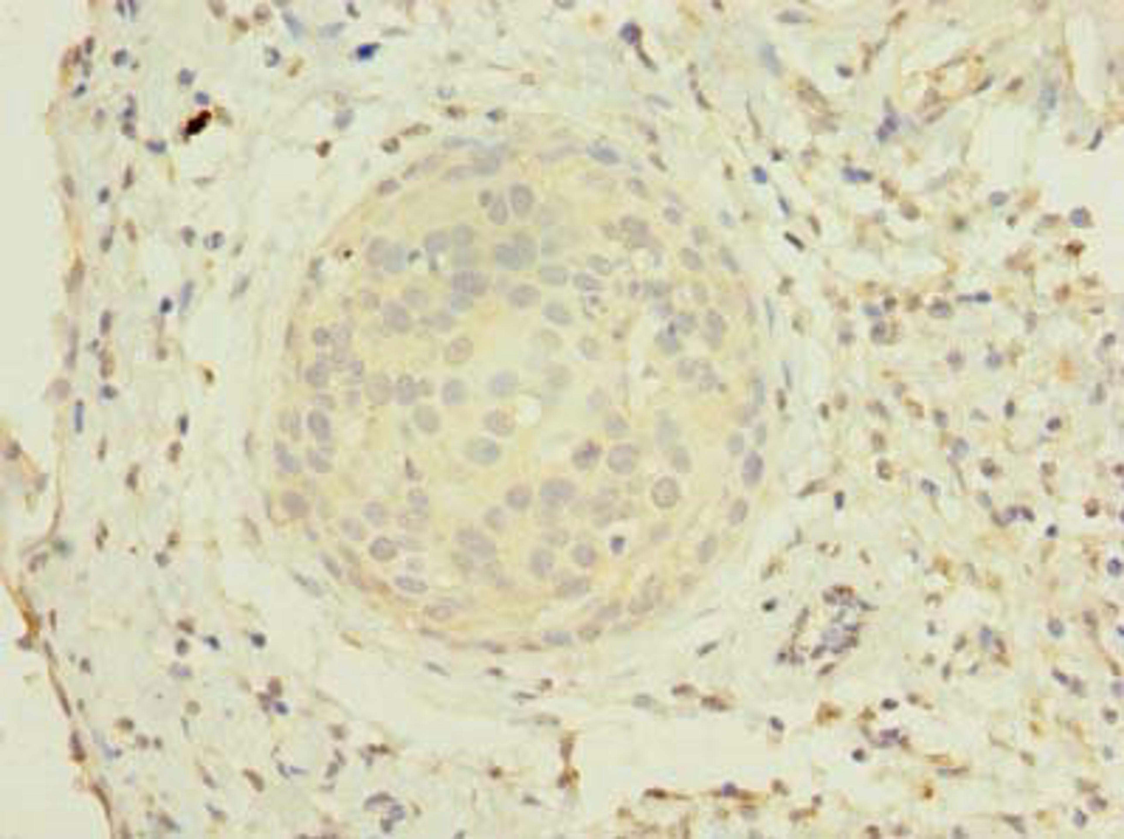 Immunohistochemistry of paraffin-embedded human cervical cancer using CSB-PA856963LA01HU at dilution of 1:100