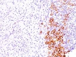 Formalin-fixed, paraffin-embedded human Hodgkin's lymphoma stained with CD30 antibody (SPM609).