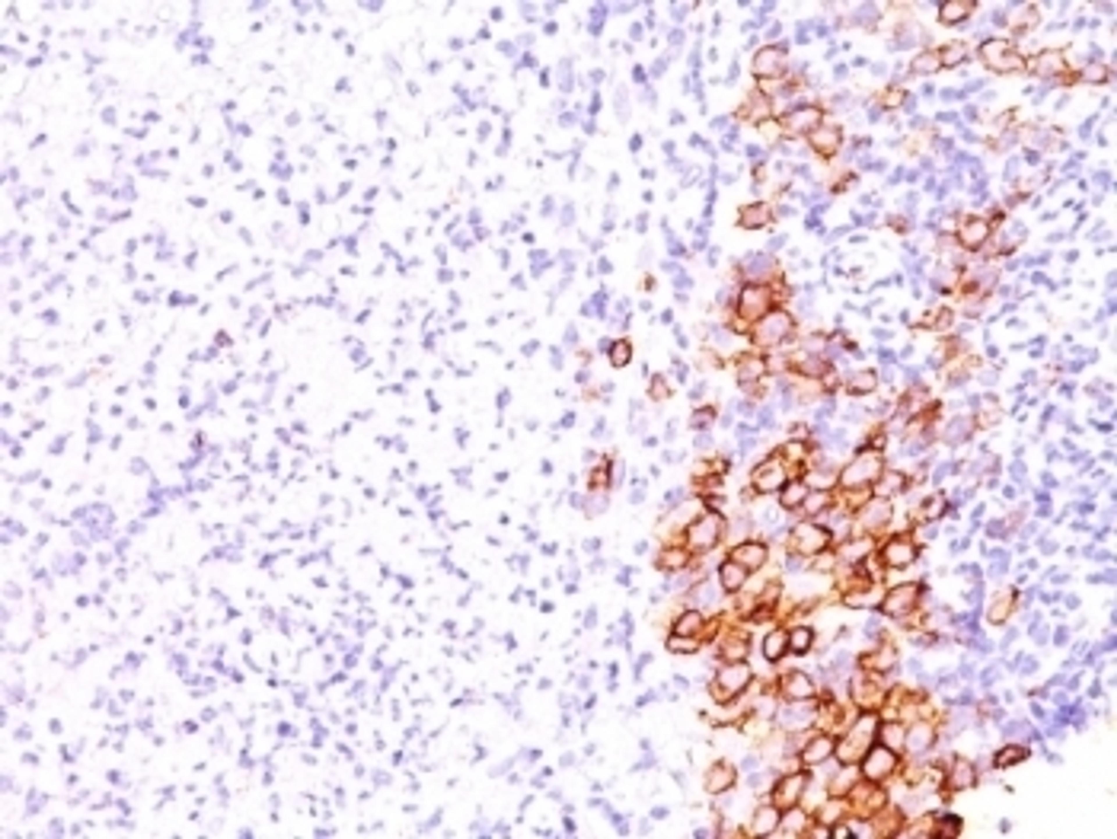 Formalin-fixed, paraffin-embedded human Hodgkin's lymphoma stained with CD30 antibody (SPM609).