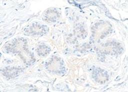 Detection of human STAT5b in FFPE breast carcinoma by immunohistochemistry.