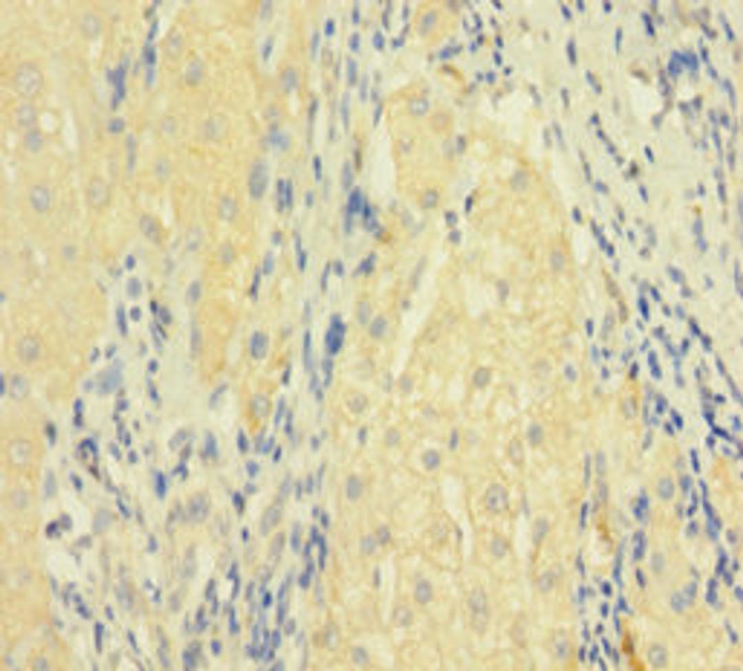 Immunohistochemistry of paraffin-embedded human liver cancer using CSB-PA008434LA01HU at dilution of 1:100