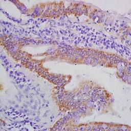 Immunohistochemical analysis of formalin-fixed and paraffin embedded human colon carcinoma tissue (dilution at:1:200) using AXL antibody