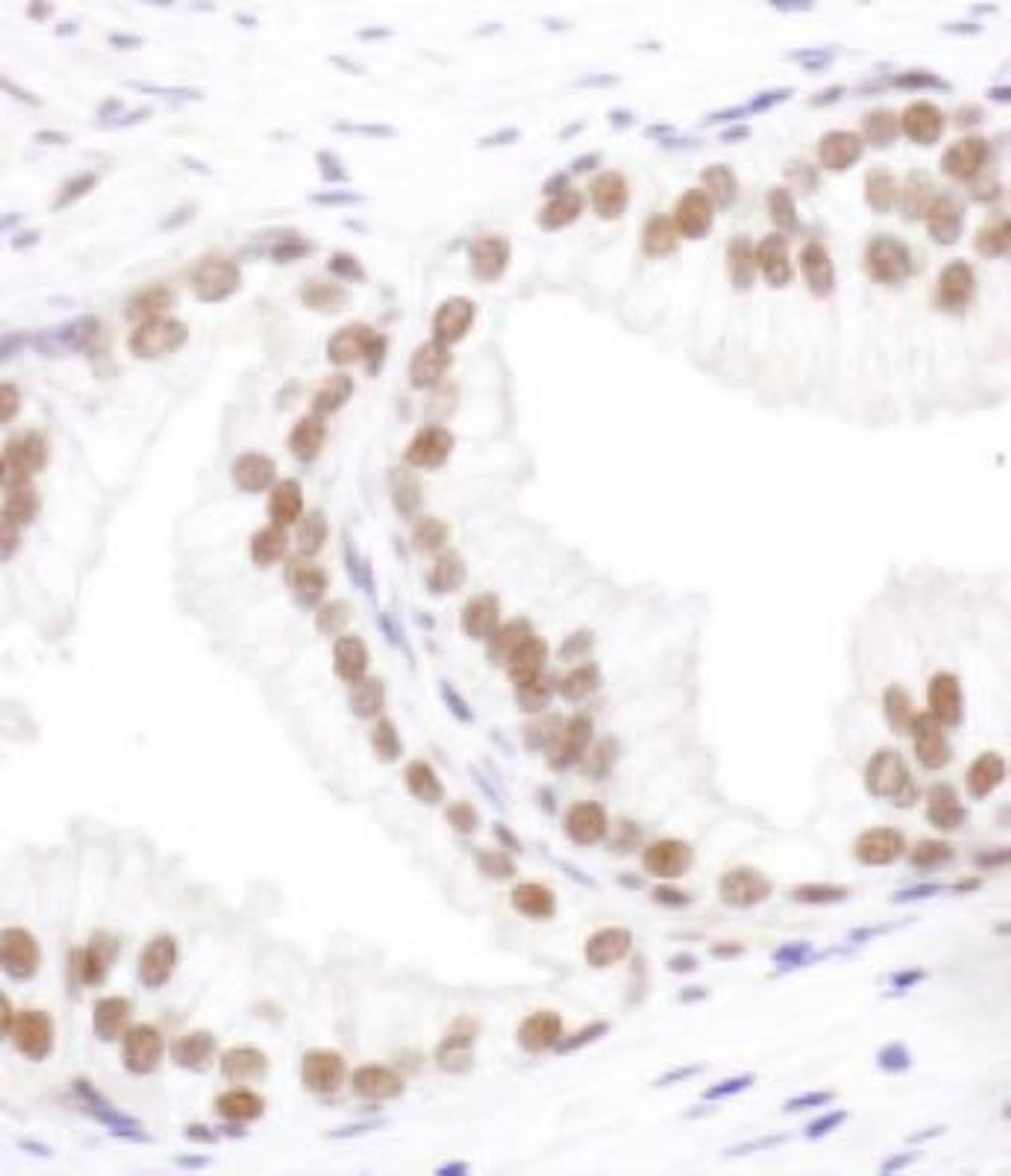 Immunohistochemistry-Paraffin: SRp55 Antibody [NBP2-04142] - FFPE section of human prostate carcinoma. Antibody:   Affinity purified rabbit anti-SRp55  used at a dilution of 1:1,000 (1ug/ml). Detection: DAB. Counterstain: Hematoxylin (blue).