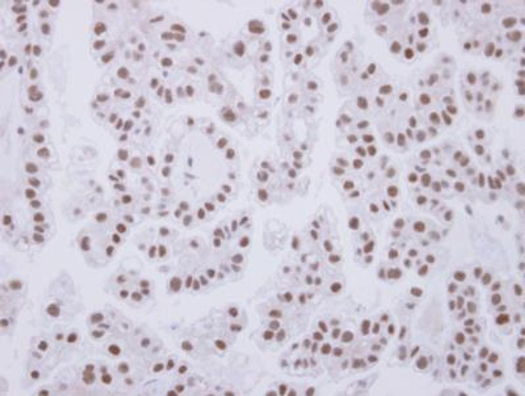 Immunohistochemistry-Paraffin: Cdk7 Antibody [NBP2-15847] - Analysis of paraffin-embedded OVCA, using antibody at 1:250 dilution.