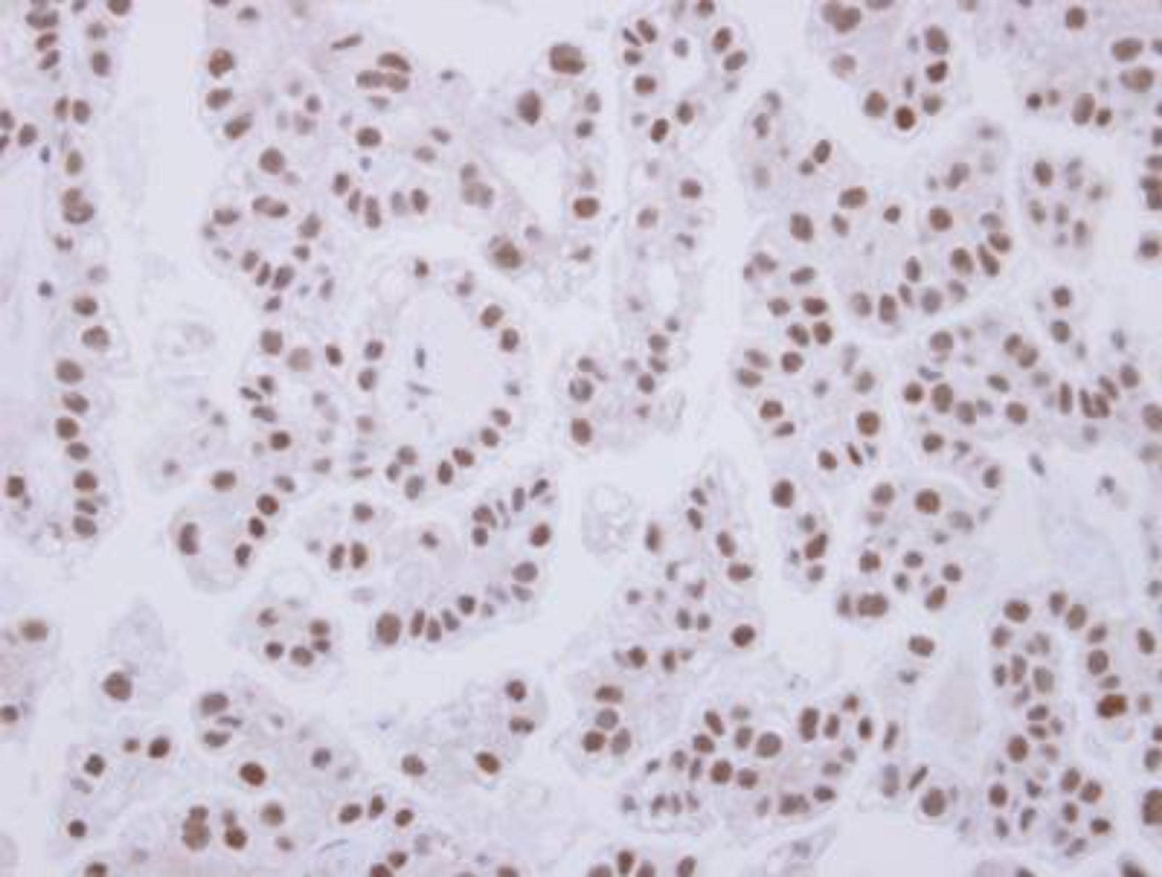 Immunohistochemistry-Paraffin: Cdk7 Antibody [NBP2-15847] - Analysis of paraffin-embedded OVCA, using antibody at 1:250 dilution.