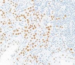 Detection of human MLH1 in FFPE testicular seminoma by Immunohistochemistry.