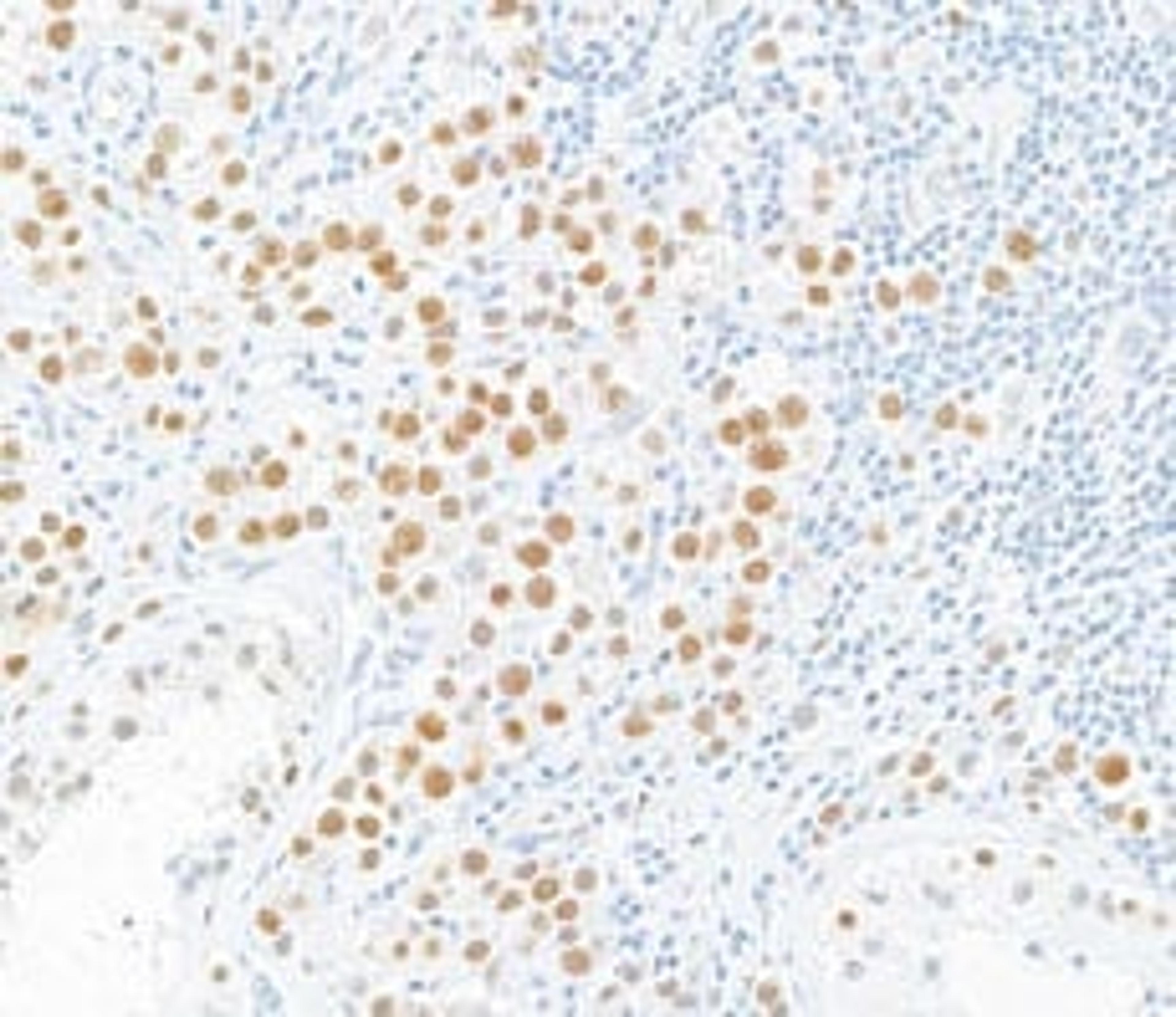 Detection of human MLH1 in FFPE testicular seminoma by Immunohistochemistry.