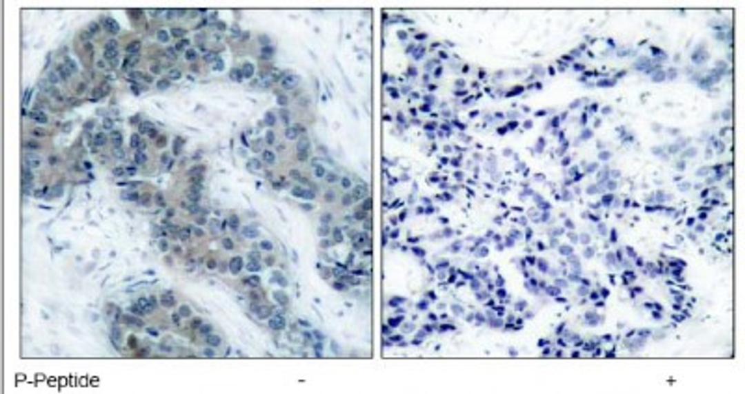 Immunohistochemistry: JAK2 [p Tyr1007] Antibody [NB100-82007] - Immunohistochemical analysis of paraffin-embedded human breast carcinoma tissue, using JAK2 (phospho-Tyr1007) antibody