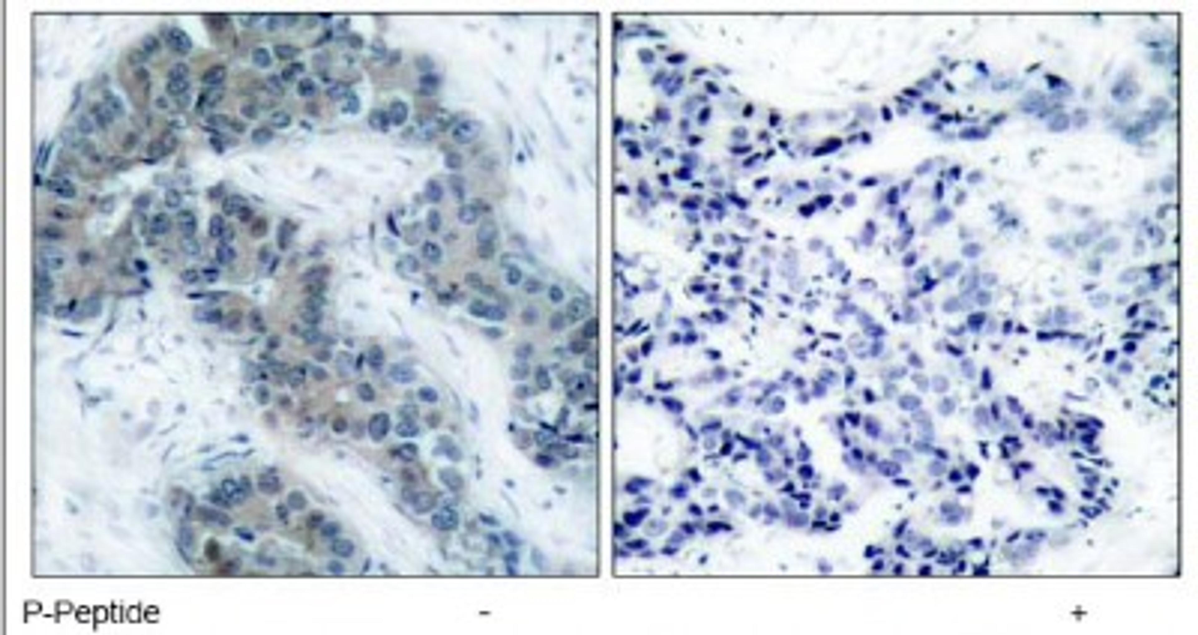 Immunohistochemistry: JAK2 [p Tyr1007] Antibody [NB100-82007] - Immunohistochemical analysis of paraffin-embedded human breast carcinoma tissue, using JAK2 (phospho-Tyr1007) antibody