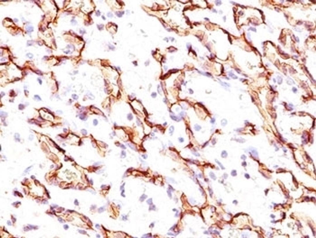 IHC testing of angiosarcoma stained with Podocalyxin antibody.