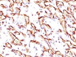 IHC testing of angiosarcoma stained with Podocalyxin antibody.