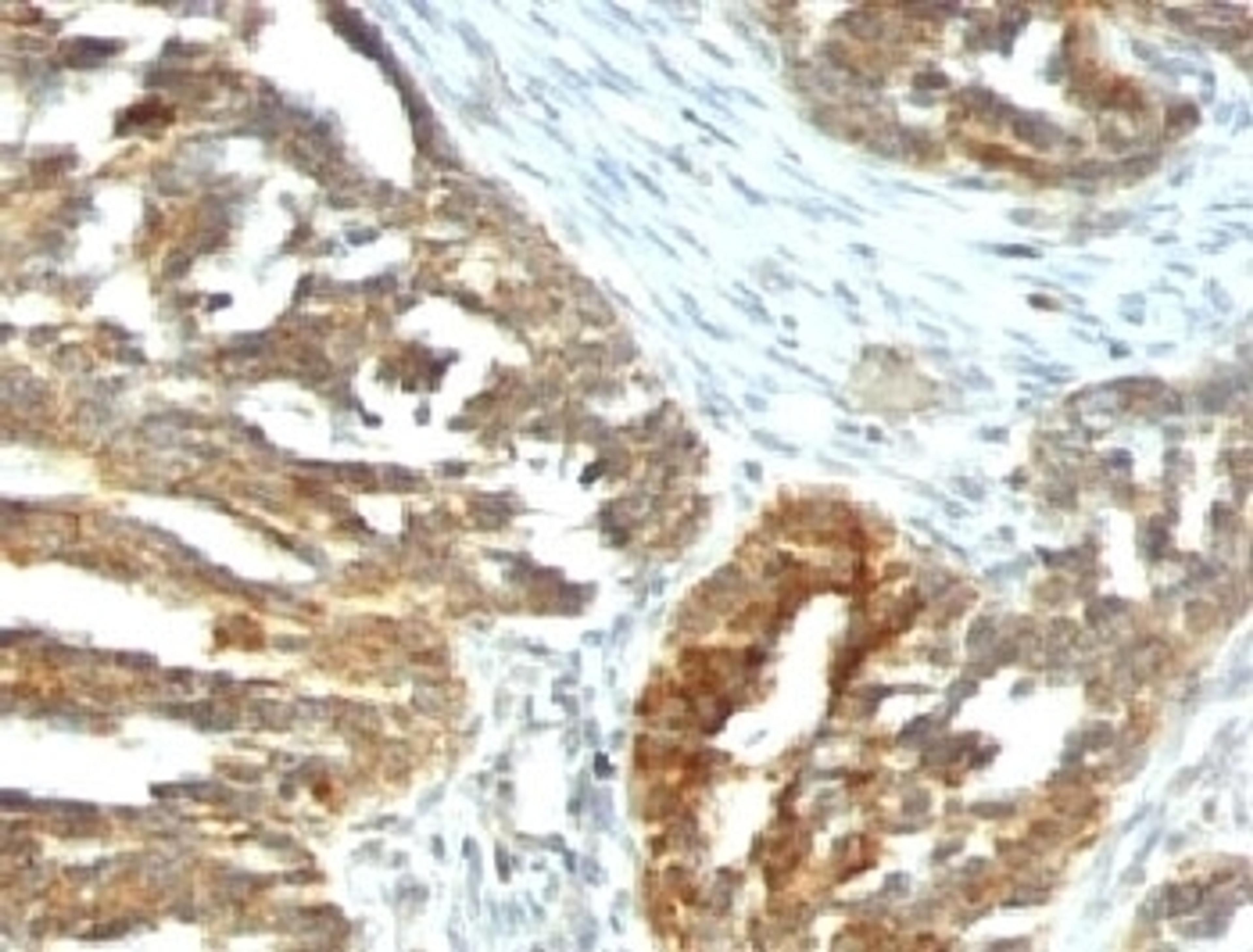 Formalin-fixed, paraffin-embedded human ovarian carcinoma stained with VEGF antibody (VEGF/1063).