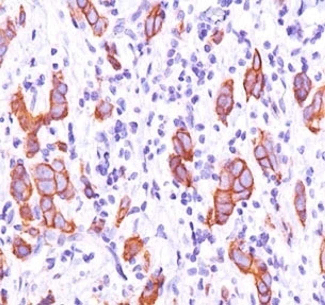 IHC testing of breast invasive carcinoma stained with HER2 antibody (HRB2/451).