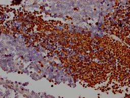 IHC image of CSB-RA258431A0HU diluted at 1:100 and staining in paraffin-embedded human lung cancer performed on a Leica BondTM system. After dewaxing and hydration, antigen retrieval was mediated by high pressure in a citrate buffer (pH 6.0). Section was blocked with 10% normal goat serum 30min at RT. Then primary antibody (1% BSA) was incubated at 4℃ overnight. The primary is detected by a Goat anti-rabbit IgG polymer labeled by HRP and visualized using 0.05% DAB.