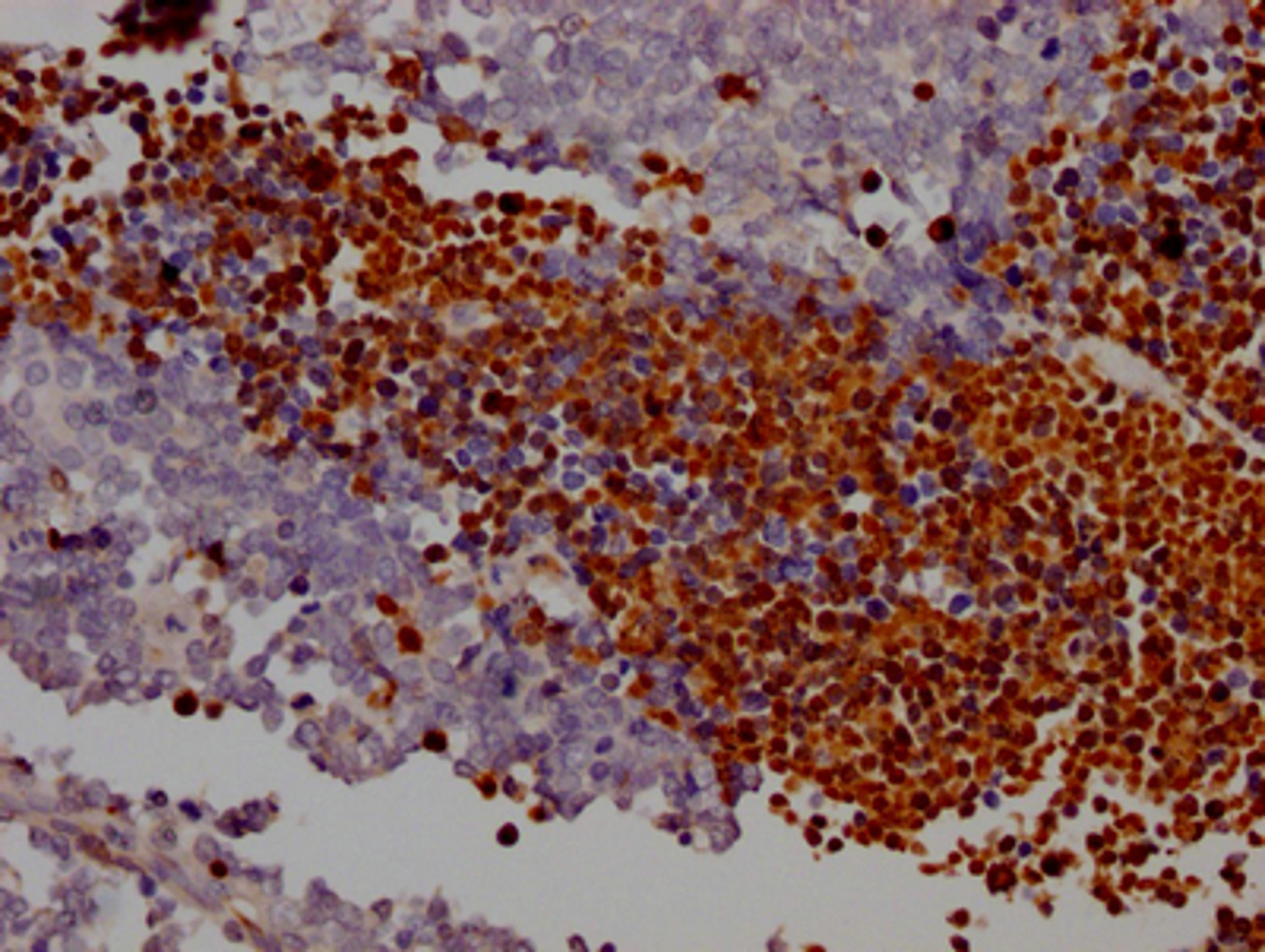 IHC image of CSB-RA258431A0HU diluted at 1:100 and staining in paraffin-embedded human lung cancer performed on a Leica BondTM system. After dewaxing and hydration, antigen retrieval was mediated by high pressure in a citrate buffer (pH 6.0). Section was blocked with 10% normal goat serum 30min at RT. Then primary antibody (1% BSA) was incubated at 4℃ overnight. The primary is detected by a Goat anti-rabbit IgG polymer labeled by HRP and visualized using 0.05% DAB.