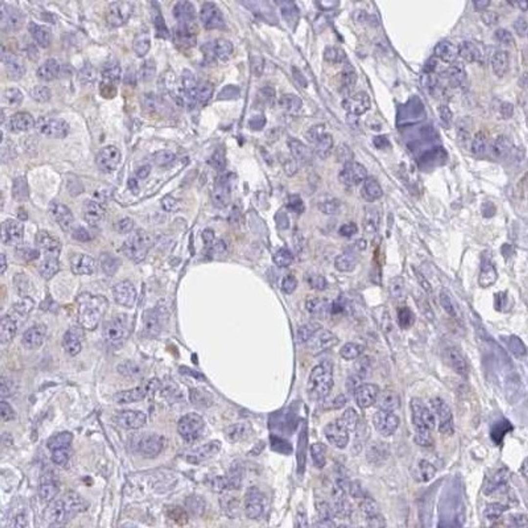 Immunohistochemistry: ZNF554 Antibody [NBP2-32519] - breast cancer