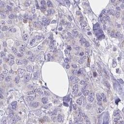 Immunohistochemistry: ZNF554 Antibody [NBP2-32519] - breast cancer