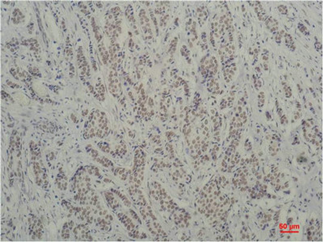 Immunohistochemical analysis of paraffin-embedded Human Breast Carcinoma using TBP/TATA Binding Protein(mAb diluted at 1:200.