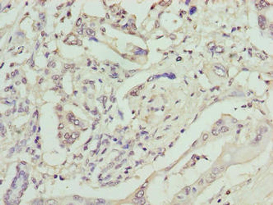 Immunohistochemistry of paraffin-embedded human pancreatic cancer using CSB-PA614417LA01HU at dilution of 1:100