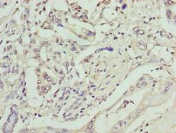 Immunohistochemistry of paraffin-embedded human pancreatic cancer using CSB-PA614417LA01HU at dilution of 1:100