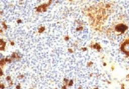 IHC testing of FFPE human Hodgkin's lymphoma and CD15 antibody (CDLA15-1).