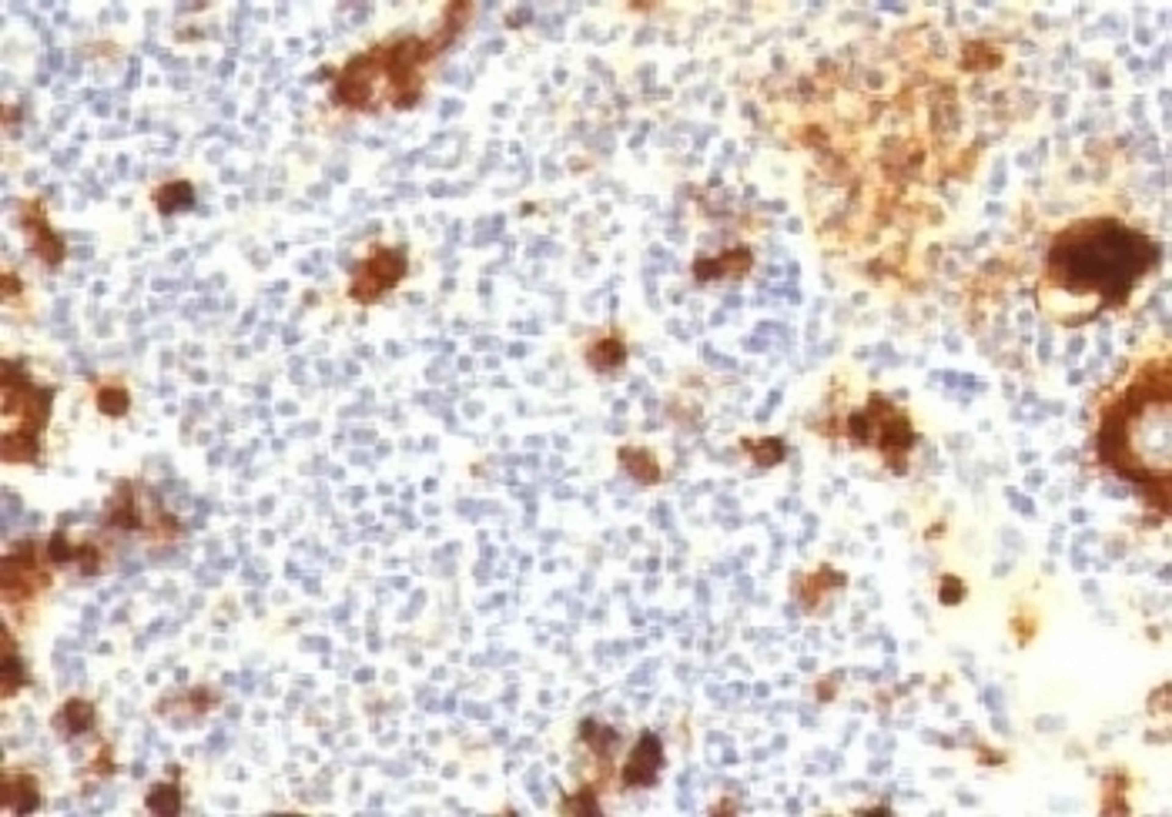 IHC testing of FFPE human Hodgkin's lymphoma and CD15 antibody (CDLA15-1).