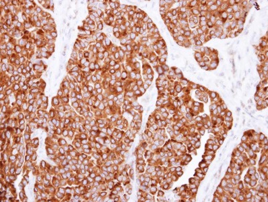 Immunohistochemistry-Paraffin: SNX7 Antibody [NBP2-20450] - Immunohistochemical analysis of paraffin-embedded Lung AdCA, using antibody at 1:250 dilution.