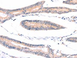The image on the left is immunohistochemistry of paraffin-embedded Human colon cancer tissue using CSB-PA708534(ADAP1 Antibody) at dilution 1/40, on the right is treated with fusion protein. (Original magnification: ×200)