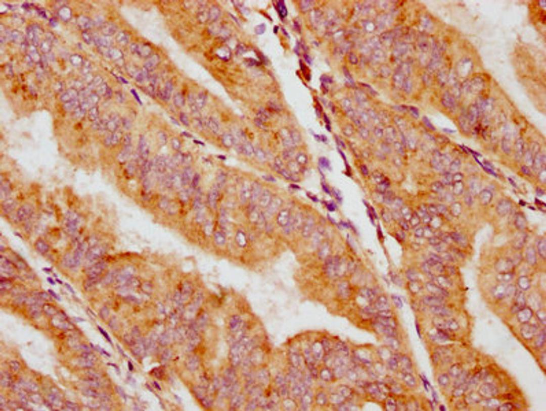 IHC image of CSB-PA004404EA01HU diluted at 1:400 and staining in paraffin-embedded human endometrial cancer performed on a Leica BondTM system. After dewaxing and hydration, antigen retrieval was mediated by high pressure in a citrate buffer (pH 6.0). Section was blocked with 10% normal goat serum 30min at RT. Then primary antibody (1% BSA) was incubated at 4°C overnight. The primary is detected by a biotinylated secondary antibody and visualized using an HRP conjugated SP system.
