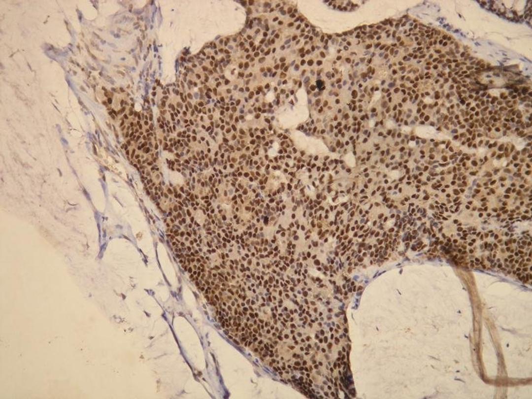 Immunohistochemical staining of paraffin embedded human mucinous breast carcinoma tissue using ER antibody