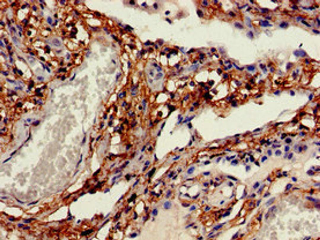 Immunohistochemistry of paraffin-embedded human lung cancer using CSB-PA005036EA01HU at dilution of 1:100