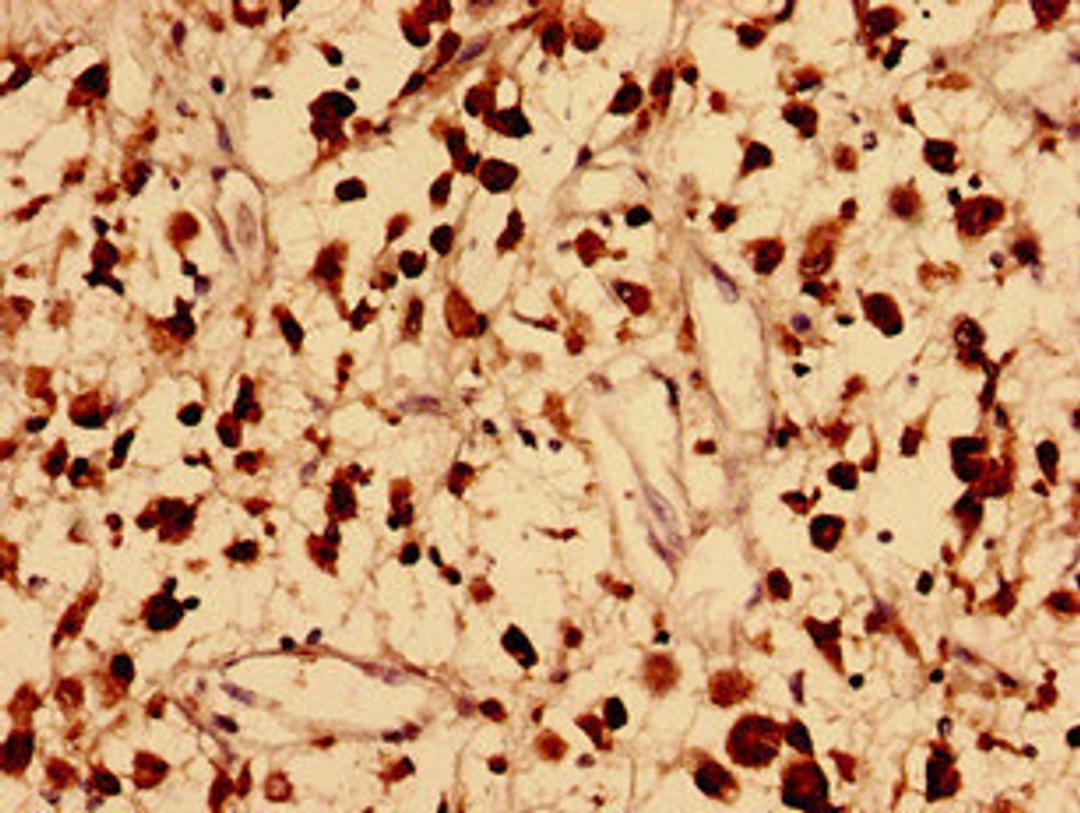 Immunohistochemistry analysis of human melanoma using CSB-PA757601LA01HU at dilution of 1:100