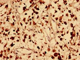 Immunohistochemistry analysis of human melanoma using CSB-PA757601LA01HU at dilution of 1:100