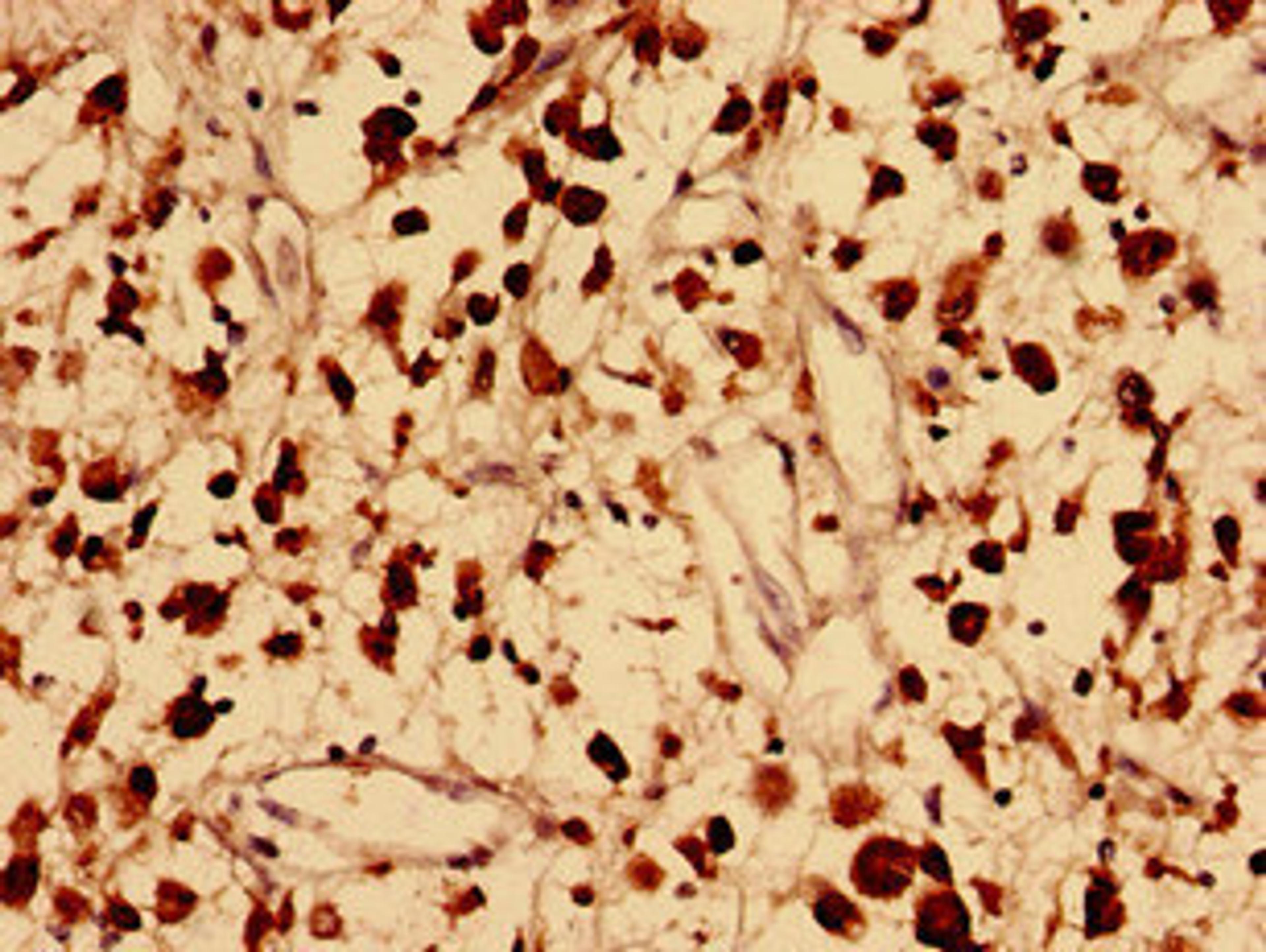 Immunohistochemistry analysis of human melanoma using CSB-PA757601LA01HU at dilution of 1:100