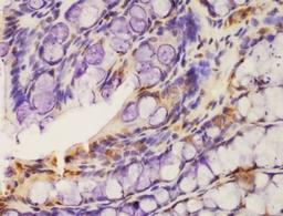 Immunohistochemical analysis of formalin-fixed paraffin embedded human lung carcinoma tissue using CSK (Phospho-Ser364) antibody (dilution at 1:200)