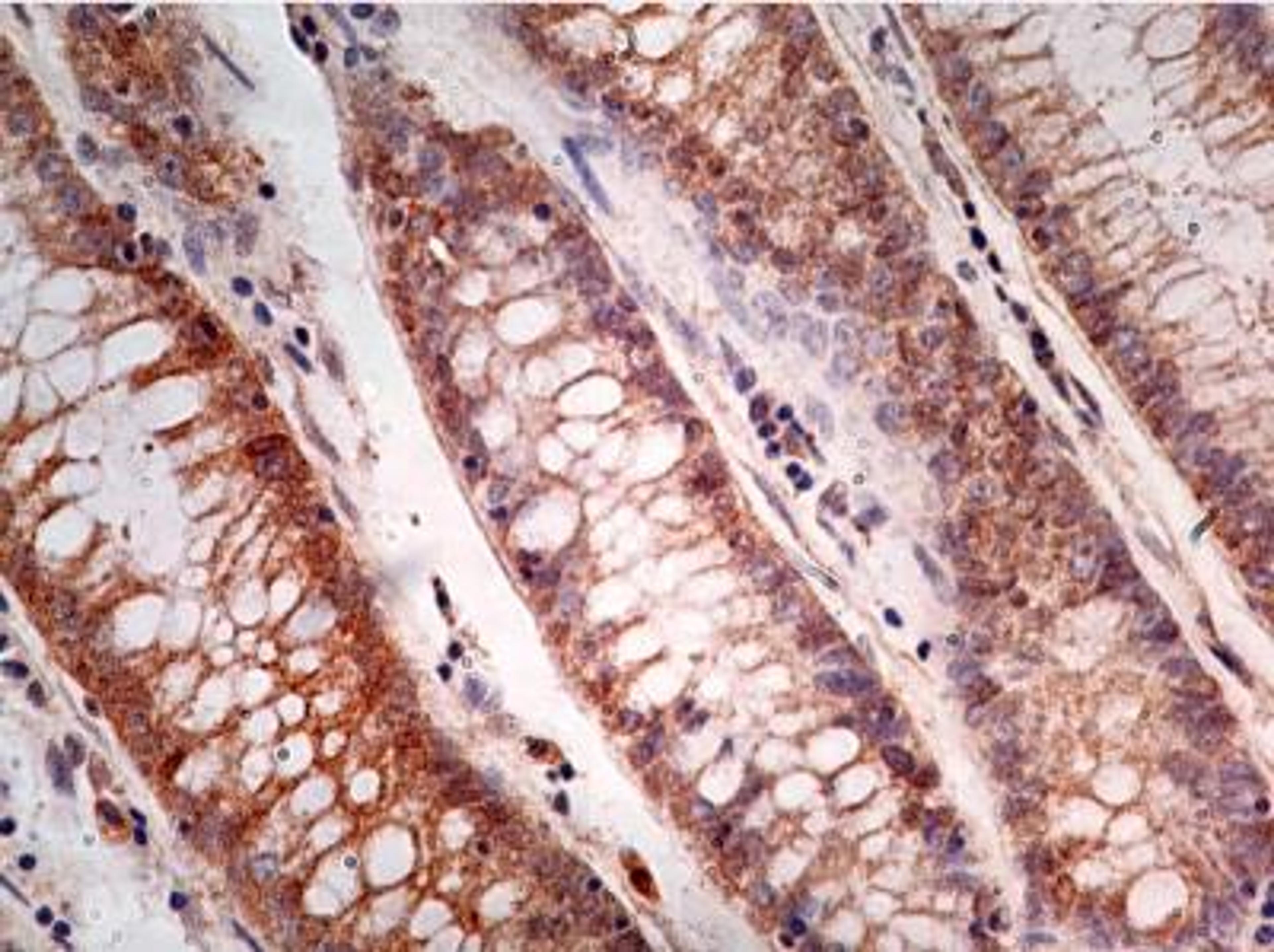 Immunohistochemistry-Paraffin: Caspase-1 Antibody (14F468) [NB100-56565] - Formalin-fixed, paraffin-embedded adenocarcinoma of the rectum stained with Caspase-1 antibody (5 ug/ml), peroxidase-conjugate and DAB chromogen. Staining of formalin-fixed tissues is enhanced by boiling tissue sections in 10 mM sodium citrate buffer, pH 6.0 for 10-20 min followed by cooling at RT for 20 min.