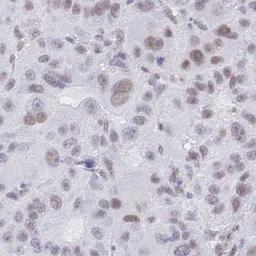 Immunohistochemistry: ISX Antibody [NBP2-32531] - liver cancer