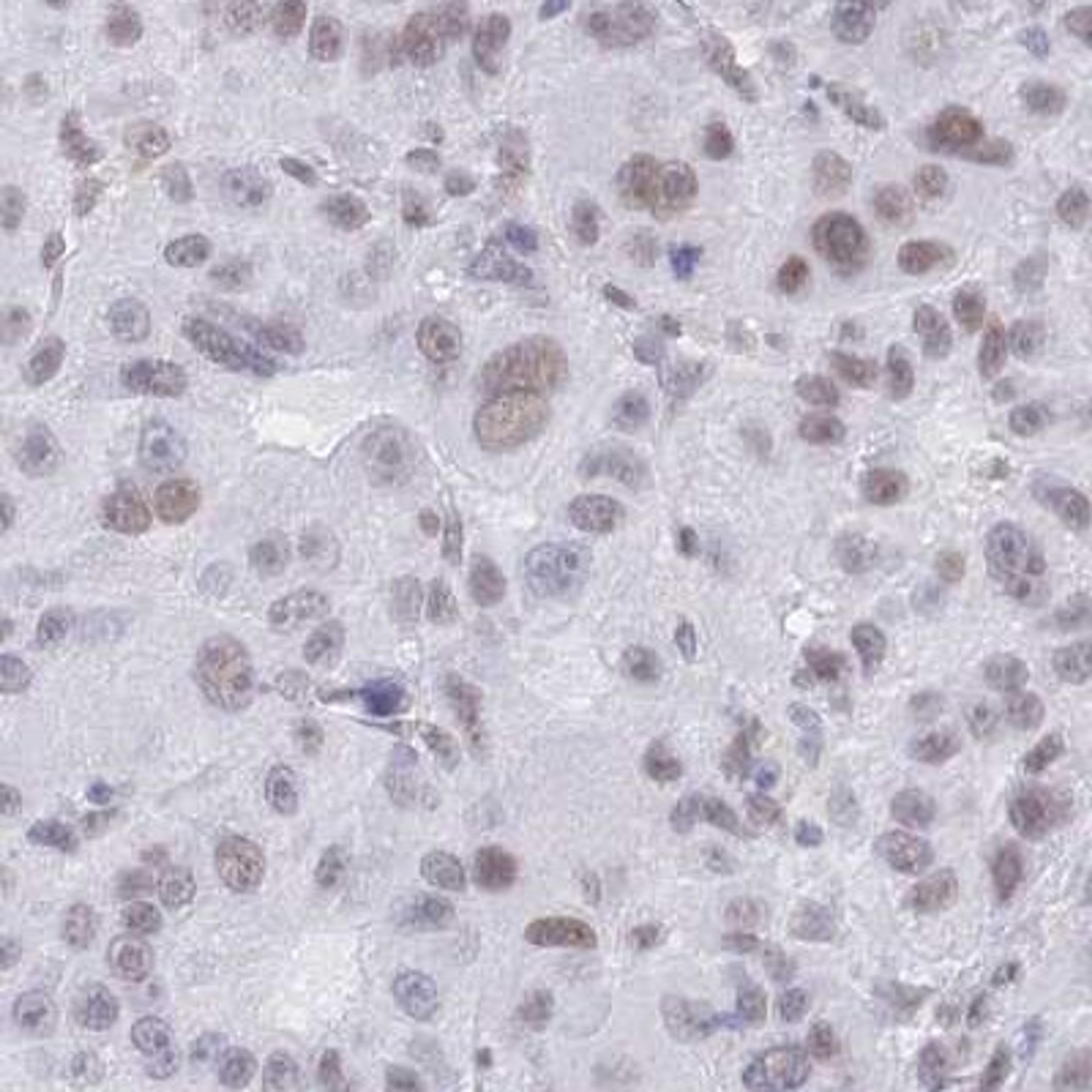 Immunohistochemistry: ISX Antibody [NBP2-32531] - liver cancer