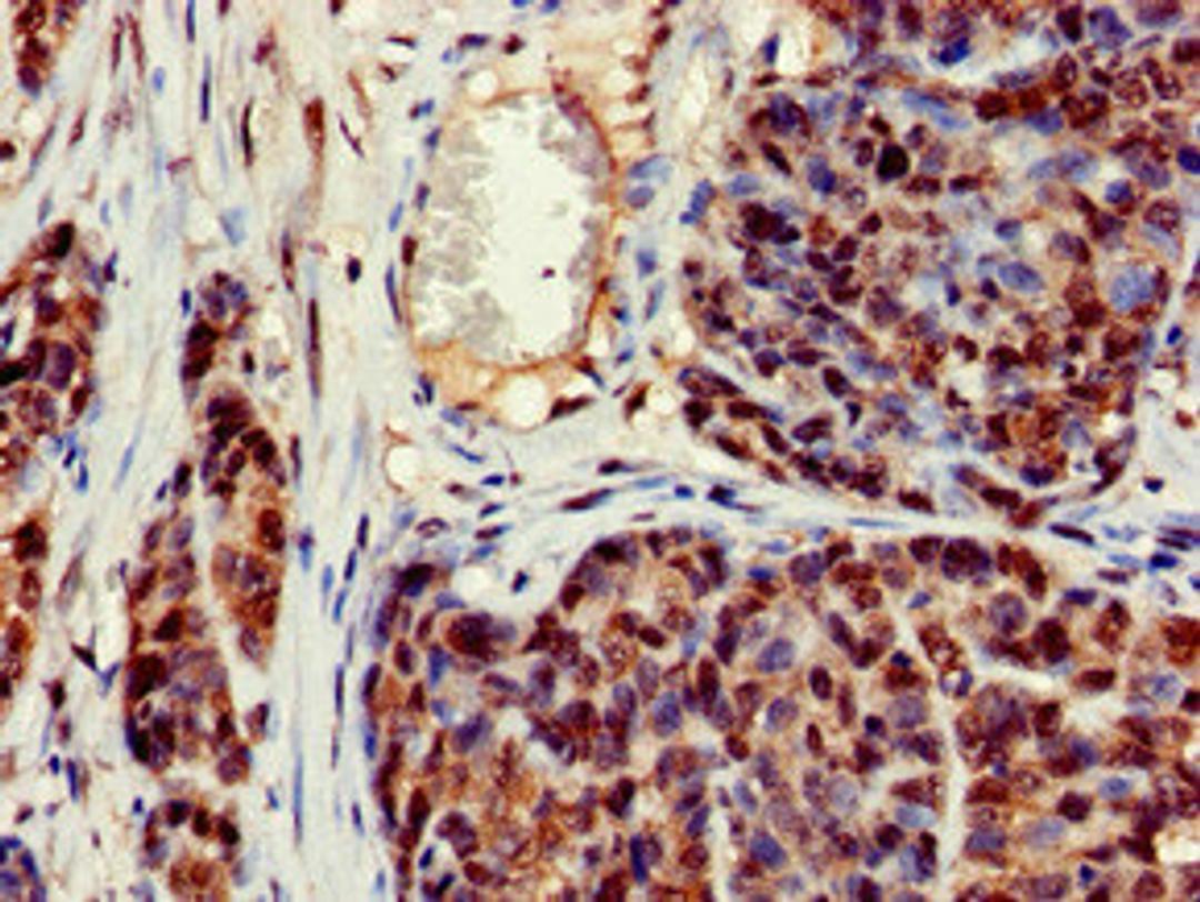 Immunohistochemistry of paraffin-embedded human ovarian cancer using CSB-PA005945LA01HU at dilution of 1:100