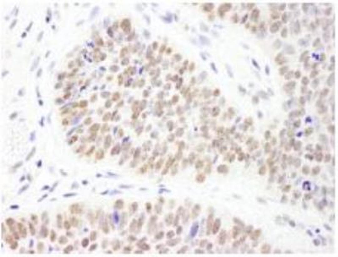 Immunohistochemistry-Paraffin: PHF6 Antibody [NB100-68262] - FFPE section of human skin carcinoma.