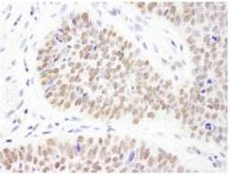 Immunohistochemistry-Paraffin: PHF6 Antibody [NB100-68262] - FFPE section of human skin carcinoma.