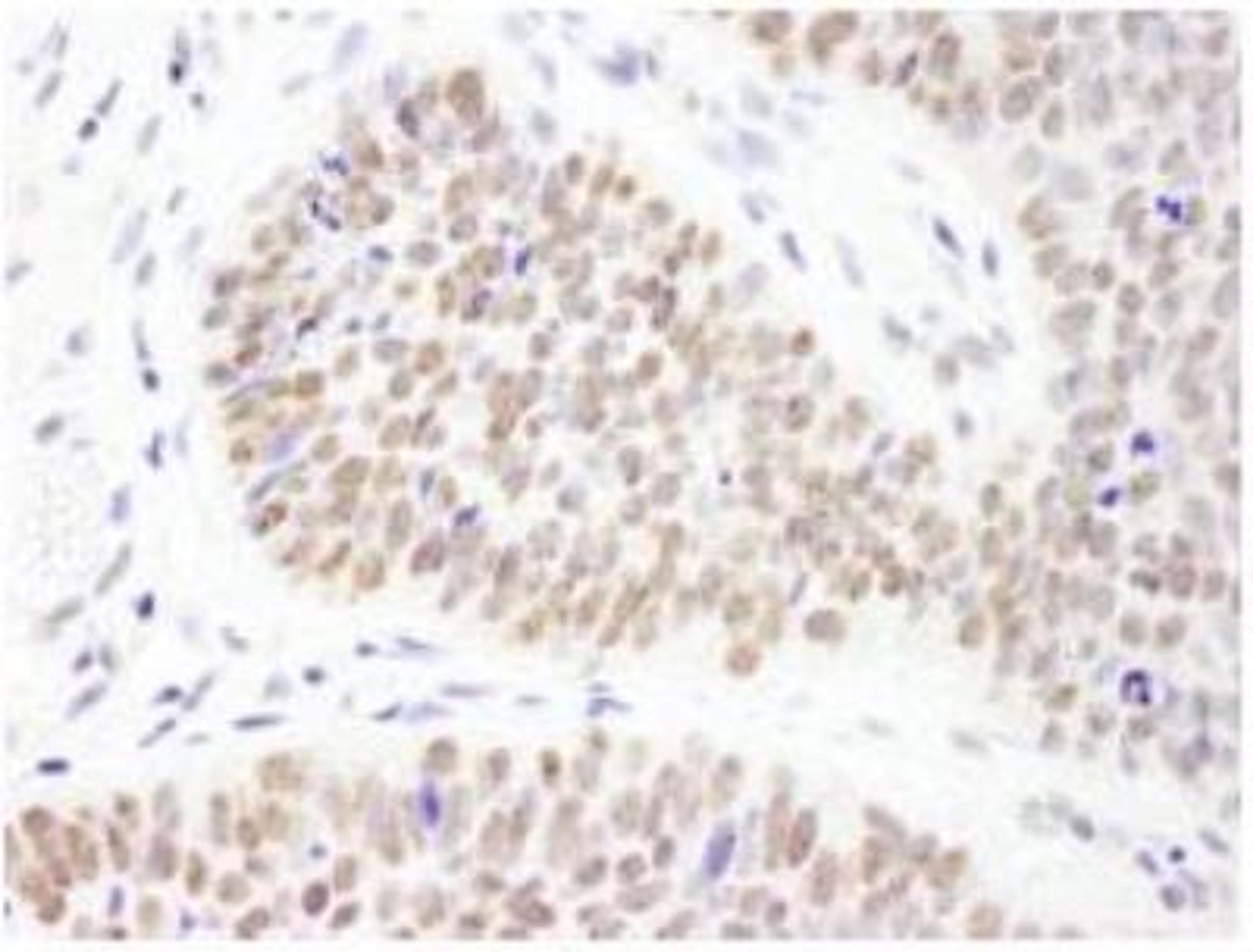 Immunohistochemistry-Paraffin: PHF6 Antibody [NB100-68262] - FFPE section of human skin carcinoma.