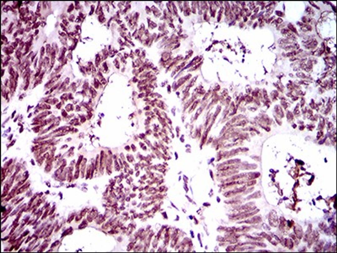 Immunohistochemistry: RING1 Antibody (8C12F4) [NBP2-37370] - Immunohistochemical analysis of paraffin-embedded rectum cancer tissues using Ring1 mouse mAb with DAB staining.