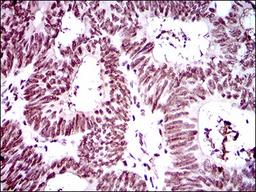 Immunohistochemistry: RING1 Antibody (8C12F4) [NBP2-37370] - Immunohistochemical analysis of paraffin-embedded rectum cancer tissues using Ring1 mouse mAb with DAB staining.