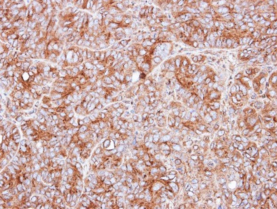 Immunohistochemistry-Paraffin: PPP3CB Antibody [NBP1-32567] - Paraffin-embedded SW480 xenograft, using antibody at 1:500 dilution.