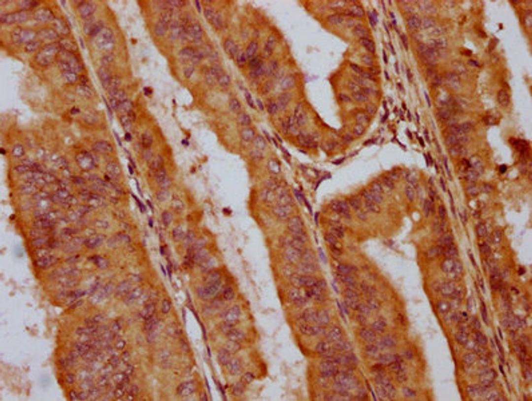 IHC image of CSB-PA722789LA01HU diluted at 1:400 and staining in paraffin-embedded human endometrial cancer performed on a Leica BondTM system. After dewaxing and hydration, antigen retrieval was mediated by high pressure in a citrate buffer (pH 6.0). Section was blocked with 10% normal goat serum 30min at RT. Then primary antibody (1% BSA) was incubated at 4&deg;C overnight. The primary is detected by a biotinylated secondary antibody and visualized using an HRP conjugated SP system.